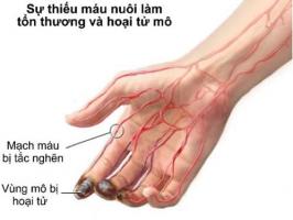 Viêm thuyên tắc mạch máu - Hình ảnh minh họa